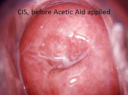 Image result for Colposcopy Findings