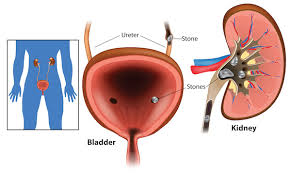 7 diet tips to prevent kidney stones | Diet and Nutrition | Men's Health |  Prevention | Women's Health | UT Southwestern Medical Center