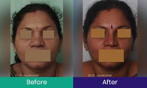 Rhinoplasty Nose Surgery Kerala Nose Job Cost Kochi