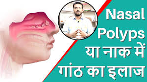 Homoeopathy is strongly recommended for management of nasal polyps, especially when they are small in size. à¤¬ à¤¨ à¤¸à¤° à¤œà¤° Nasal Polyps à¤• à¤‡à¤² à¤œ Nasal Polyps Homeopathic Medicine Nasal Polyps Treatment Hindi Youtube