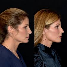 3 months after extended deep plane facelift, neck lift, fat transfer, lip  lift and lateral browlift for this beauty. She took my breath away when I  opened my office door today to