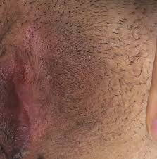 The virus is able to enter the body through the soft linings of the mouth, vagina, rectum, So Confused Genital Herpes Simplex Forums Patient