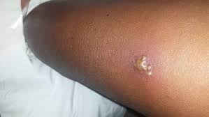 While most people will feel the painful bite and see some redness and swelling around the puncture marks, false widows don't normally do lasting apparently the bite of the false widow feels like a bee sting but i didn't feel a thing. Woman Fears She Will Lose Leg After Being Bit 10 Times By A False Widow Spider Which Became Trapped In Her Jeans Essex Live