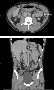 Image result for Adult Intussusception