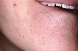 How do i get rid of whiteheads. How To Get Rid Of Whiteheads Tips And Home Remedies To Remove Whiteheads