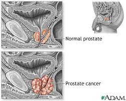 It can be hard to pinpoint prostate cancer symptoms, because they usually start late in the disease and they can mimic symptoms of a benign, enlarged prostate, which is also more common in older men. Prostate Cancer Information Mount Sinai New York
