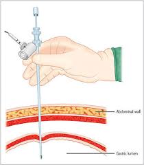 The witzel technique can be used to create a jejunostomy either at the conclusion of a surgical procedure or as an isolated procedure. Jaypeedigital Ebook Reader
