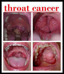 Throat cancer may also look like unusual white patch of tissue termed as leukoplakia. People Who Died From Throat Cancer