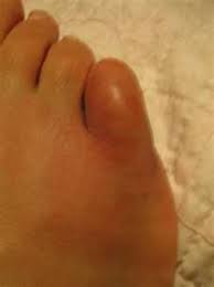 Your pinky toe might seem like it serves no real function but to look cute. Symptoms You Have A Broken Pinky Toe Or Stubbed Toe Difference In Shooting Pains And The Healing Process Hubpages