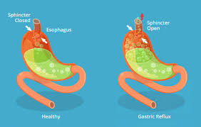 Image result for Pediatric Reflux