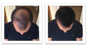 Benefits of ginger for hair growth. Ginger For Hair Loss Before And After Effects Step By Step Guide
