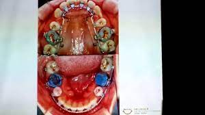 Check spelling or type a new query. Orthodontic Retreatment With Deep Bite And Open Space Youtube