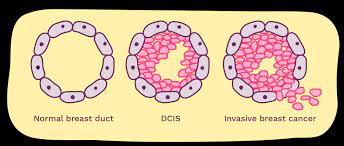 What does carcinoma stand for? Dcis Ductal Carcinoma In Situ Explained Breast Cancer Now