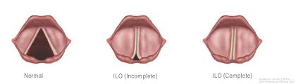 Image result for Vocal Cord Dysfunction