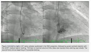 Image result for Nuclear Ventriculogram