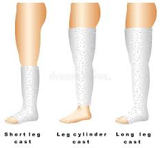 Image result for Short Leg Cast