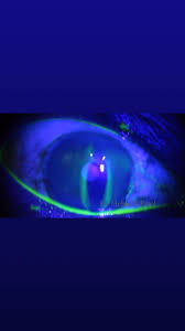 Image result for Seidel Test