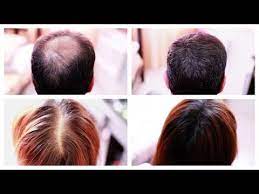 How To Cover Up Hair Loss Bald Spots Thinning Hair Receding Hairline Effectively A Must See Hairstyles For Thin Hair Henna Hair Henna Hair Dyes