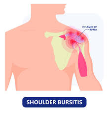 The major bursae in the shoulder include. Shoulder Bursitis Treatment Las Vegas Lake Havasu Mesquite Pahrump Nevada