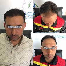 6 Ay Sonra Ki Degisim 5200 Greft Sac Ekimi Ve Profesyonel Ekip Ile Emin Ellerdesiniz Bizi Tercih Eden Hastamiza Tesekkur Eder Yeni Hair Clinic Hair Wearable