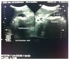 Laparoscopic Cholecystectomy In A Patient With Ventriculoperitoneal Shunt System Boletin Medico Del Hospital Infantil De Mexico English Edition