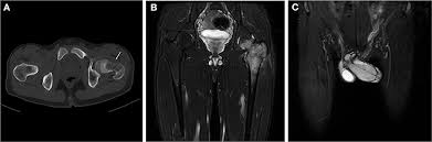 Ewing is a family medicine doctor in richmond, virginia. Frontiers Case Report Primary Ewing Sarcoma Of The Penis With Multiple Metastases Pediatrics