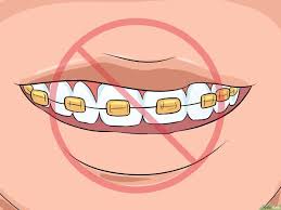 1.warna biru dicampur warna merah jadi warna apa 2.warna kuning dicampur warna pink jadi warna apa 3.warna hijau dicampur warna jingga jadi warna apa. Cara Memilih Warna Behel Kawat Gigi 14 Langkah Dengan Gambar