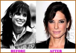 Pin On Celeb Surgery