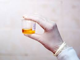 Creatinine Urine Test Understanding The Test And Results