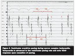 Atrial overdrive pacing during tachycardia can rapidly differentiate jt from avnrt, which can improve the safety and efficiency of catheter ablation of these arrhythmias. Ep 101 A Surprise Visitor At The End Of An Ablation Ep Lab Digest