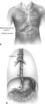 It is used to treat patients with benign and malignant disease of the esophagus or esophageal cancer. Technique Of Open Ivor Lewis Esophagectomy Operative Techniques In Thoracic And Cardiovascular Surgery
