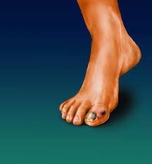 Image result for Acral lentiginous melanoma nail