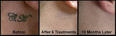 Surgically removing the tattoo is also likely to leave a scar. Laser Tattoo Removal