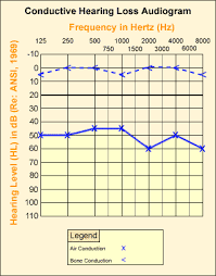 Db Hl Sensitivity To Sound Clinical Audiograms