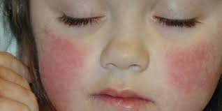 Kalau tidak diobati, penyakit menular inibisa sembuh sendiri dalam kurun waktu. 12 Penyebab Kulit Merah Pada Tubuh Salah Satunya Karena Pengaruh Emosi Merdeka Com