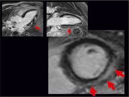Myocarditis is inflammation of the heart muscle. Miocarditis Sociedad Espanola De Cardiologia