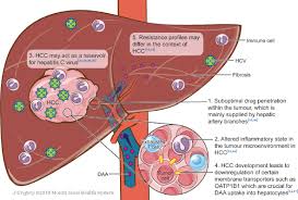 Hepatitis c virus (hcv) is a major cause of liver diseases including liver cirrhosis and hepatocellular carcinoma. Management Of Concomitant Hepatocellular Carcinoma And Chronic Hepatitis C A Review