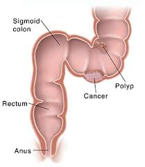 Colorectal Cancer Screening Saint Luke S Health System