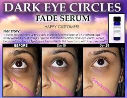 Pin On Dark Circles Baking Soda