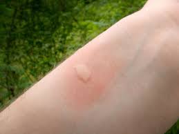 Momento Da Seguranca Wa Alergia A Picadas De Mosquitos Pulgas E Carrapatos