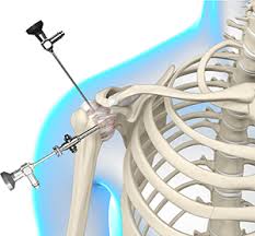4.7 out of 5 stars. Arthroscopic Frozen Shoulder Release Milwaukee Minimally Invasive Shoulder Surgery Franklin