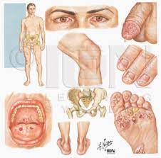 Selain itu, beberapa jenis kanker kulit juga bisa terlihat seperti kutil kelamin. 30 Gambar Kartun Penyakit Sifilis Gambar Kartun Hd