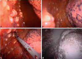 Your guide to the different types of mesothelioma and how this helps your doctor decide which treatment you need. Management Of Malignant Pleural Mesothelioma Part 1 Epidemiology Diagnosis And Staging Springerlink