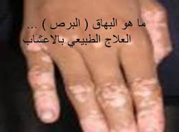 ما هو مرض البرص لم نعرفه الا باسمه الاخر غرور وكبرياء