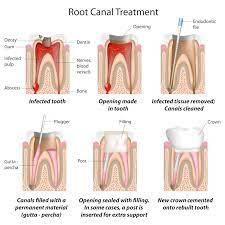 Pulp Therapy In Children Frisco Kid S Dentistry