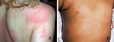 Image result for Hives