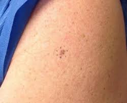 In the united states, it's estimated that doctors diagnose over 100,000 new skin cancer cases each year. Skin Cancer Warning Signs