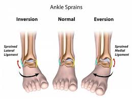 A More Effective Way To Rehab Your Ankle Sprain Sprained Ankle Ankle Injury Ankle Ligaments