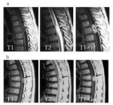 【視神経脊髄炎nmo】：抗aqp4体 現在msと別の疾患と考えられている。 「抗アポクリン4抗体」が検出され、独立した疾患である。 高齢女性、3椎体以上に及ぶ著大な脊髄病巣を認めることが多い。 ▷pslパルス、血漿交換. è„Šé«„è…«ç˜ Kompas