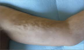 Does your skin every resemble an orange peel? Orange Peel Appearance Of The Skin Of The Upper Arm Download Scientific Diagram
